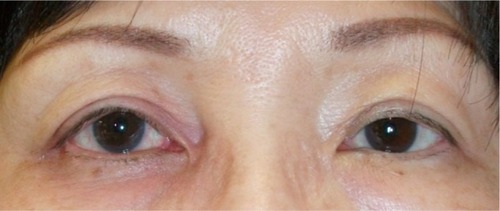 Figure 2 Postoperative clinical photo of patient’s eyelids.
