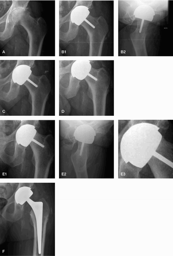 Figure 1. A. Preoperative radiograph showing osteoarthritis of the left hip without signs of avascular necrosis (AVN) or large femoral head cysts. B. Postoperative radiographs showing ordinary implant position after resurfacing arthroplasty in anterior-posterior view (B1) and in axial view (B2). C. Radiographic follow-up 1 year postoperatively showing unchanged implant position. D. Radiographic follow-up 2 years postoperatively showing a discrete change in the position of the femoral component. E. Radiographs 3.5 years after the index procedure showing varus tilting of the femoral component and a fracture of the femoral neck in anterior-posterior view (E1) and in axial view (E2); panel E3 is a closeup of panel E1. F. Radiograph taken after revision surgery showing conventional femoral component equipped with a large-diameter metal head.