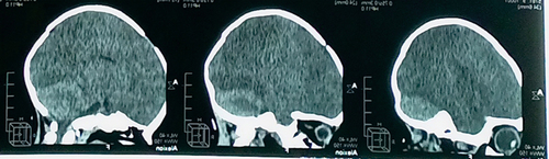 Figure 2 Computed Tomographic scan of the head in sagittal view, demonstrates hypo-density of both brain hemispheres with loss of white-grey matter differentiation and the “White Cerebellum” sign in relation to hypoxic-ischemic lesions.