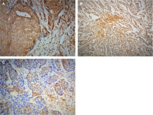 Figure 3 IDO immunostaining images.Notes: IDO protein expression in breast cancer tissue (n=100) was evaluated by immunohistochemistry. Formalin-fixed paraffin-embedded sections were stained using mouse monoclonal antibody against human IDO. (A) Strong and diffuse IDO staining was observed in malignant ductal tumor cells. (B) Moderate IDO-positive staining was detected in invasive ductal tumor cells. (C) Weak IDO staining was observed in the breast tumor cell. Images were captured at 40× magnification.Abbreviation: IDO, indoleamine 2,3 dioxygenase.