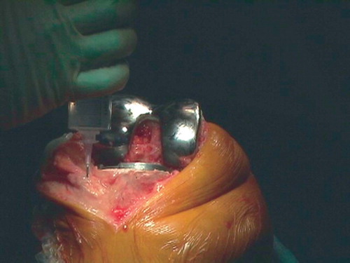 Figure 1. Infiltration of the anterior part of the capsule.