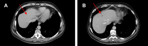 Figure 4 (A) Red arrows show liver metastases at baseline and (B) after 10 cycles of therapy with ribociclib.