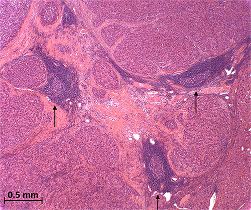 Figure 1 Tertiary lymphoid structures (arrows) inside a surgically resected moderately differentiated hepatocellular carcinoma (H&E 40x).