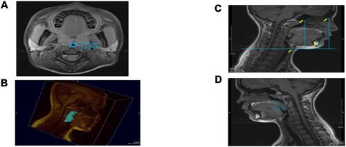 Figure S10 (A) CSA oropharyngeal airway. (B) Combined upper airway volume, T1 weighted axial scan. (C) Transverse line perpendicular to the floor passing through the hyoide to nasion, to sella to supramentale. (D) Midsagittal palatal CSA.Note: Reprinted from Int J Pediatr Otorhinolaryngol, 77(1), Cappabianca S, Iaselli F, Negro A, et al., Magnetic resonance imaging in the evaluation of anatomical risk factors for pediatric obstructive sleep apnoea-hypopnoea: a pilot study, 69–75, Copyright 2013, with permission from Elsevier.Citation124