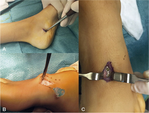 Figure 4. Operative pictures. A: Incision for the percutaneous plantar release. B: A dorsal incision for insertion of the plate is made; the physis is located with the help of a needle and confirmed under an image intensifier. C: detail of the inserted plate.