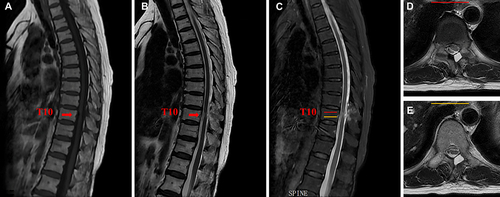 Figure 5 MRI sagittal (A–C) and axial (D and E) of post-operation showed that the IDEM tumor was removed completely, and the spinal cord returned to a normal position. The red and yellow lines represent the axial planes in (C).