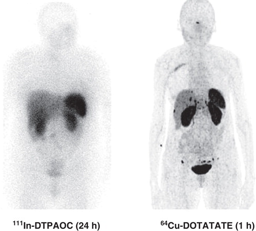 Figure 1. Head-to-head comparison of 111In-DTPA-octreotide (111In-DTPAOC) and 64Cu-DOTATATE. Please note the additional foci in liver and carcinomatosis only seen on the 64Cu-DOTATATE scan.