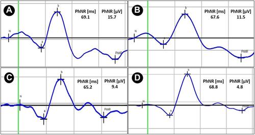 Figure 1 Photopic electroretinograms with measurements (latency and BT amplitude) of PhNR in (A) a control, (B) a mild glaucoma case, (C) a moderate glaucoma case and (D) a severe glaucoma case.