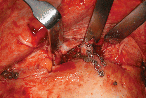 Figure 2. Intra-operative view after repositioning and fixation of the non-comminuted left orbito-zygomatic fracture at the zygomatico-frontal suture and repositioning and fixation of the nasal ridge area at both naso-maxillary medial buttresses.