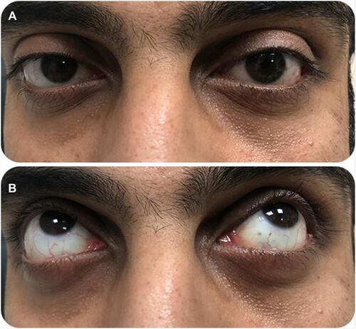 Figure 4 Postoperative photographs in the primary gaze (A) and supraduction (B) positions showing significant correction of the inferior sulcus after the BOF and resolving enophthalmos. The patient was followed up for one year and showed no complications.