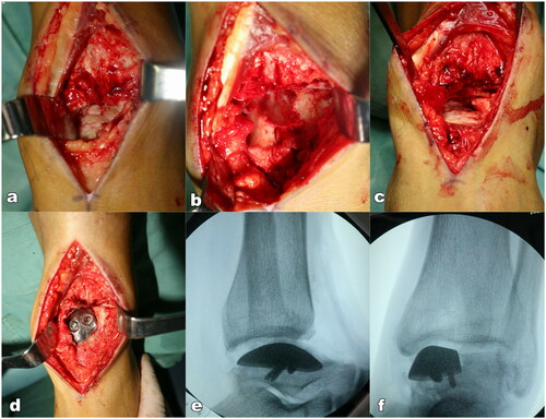 Figure 6. The operating process. (a) Exposure of the affected talus; (b) Remove the necrosis tissue and show defect of the talus; (c) Osteotomy of talus; (d) Prothesis implantation; (e,f) Lateral and anteroposterior x-rays after the talus prosthesis replantation.