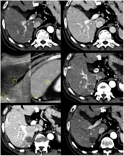 Figure 5. Technical Failure with a residual unablated tumor in a 69-year-old male patient.A 0.4-cm-sized arterially enhancing nodule (arrowhead, upper left) with portal phase washout (arrowhead, upper right) was not visualized on B-mode ultrasound. RFA was performed under US-CT fusion guidance (arrow and arrowhead, middle left). In the immediate follow-up CT, nodular arterial phase enhancement (arrowhead, middle right) with portal phase washout (arrowhead, lower left) was noted but was mistakenly interpreted as a part of a treatment-related hyperemic rim. In the one-month follow-up CT, residual unablated tumor tissue is clearly delineated (arrowhead, lower right).RFA: radiofrequency ablation; CT: computed tomography.