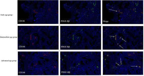 Figure 3 Immunofluorescence staining of CD146+ and PDGF-Rβ+ in human endometrium. For the positivity, mean density and area density of the combination of CD146 and PDGF-Rβ immunofluorescence staining, no significant differences were found among the three groups (p>0.05). CD146+ and PDGF-Rβ+ cells are mainly expressed in endometrial basalis and functionalis vessels (arrow).