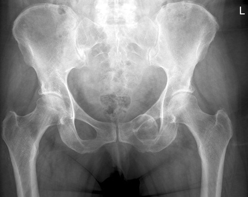 Figure 5. The pelvic chondrosarcoma.