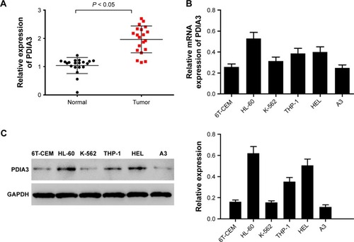 Figure 1 PDIA3 expression in 20 bone marrow tissues of acute myeloid leukemia (AML) and normal tissues.