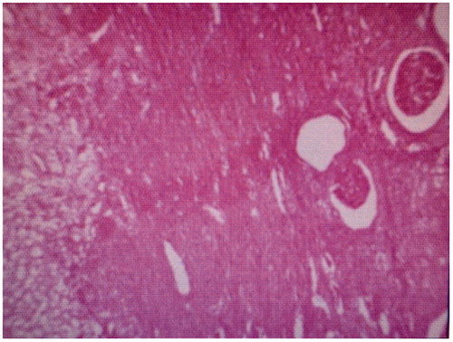 Figure 1. Hematoxylin and eosin stain of the left kidney: Renal cell carcinoma (40×).