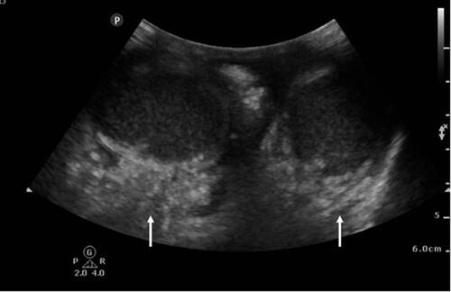 Figure 4 Point of care ultrasound image of the scrotum. Note the diffuse subcutaneous edema and subcutaneous gas adjacent to the testicles (white arrows). Case courtesy of Praveen Jha. Fournier gangrene. Radiopedia.org. rID: 18695. Available from: https://radiopaedia.org/cases/fournier-gangrene-1?lang=us.Citation100