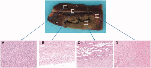 Figure 4. Comparison of the ablation zones in the specimens and hematoxylin and eosin tissue taken from different areas using a light microscope (×200). (A) Normal liver. (B) Vascular wall. (C) Central ablation zone. (D) Peripheral ablation zone. All specimens were obtained 24 h after ablation.