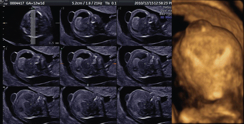 Figure 24.  Cephalocele at 12 weeks of gestation Cephalocele containing translucent fluid is seen on the parietal right side of the head. This cyst disappeared 2 weeks later.
