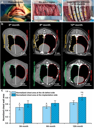 Figure 6. The chest wall morphology and chest area were improved after the implantation of biodegradable PCL RI. (a) Construction of rib defects in canine models and implantation of the 3D-printed RI. (b) CT scan images of the chest wall without and with the implantation of RI during 12 months of follow-up. (c) Changes in the normalised chest area of the rib defect side (marked by orange dash lines) and implantation side (marked by green dash lines) as normalised by the healthy chest area (marked by red dash lines) during 12 months of follow-up.