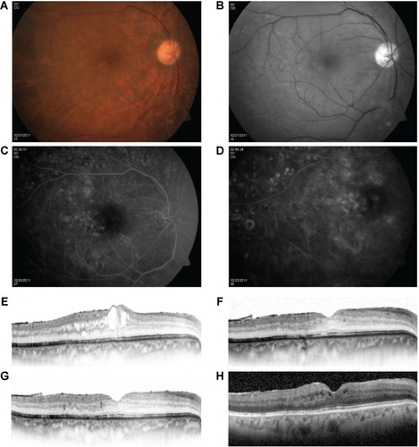 Figure 1 A 64-year-old male diagnosed with diabetic macular edema in the right eye.