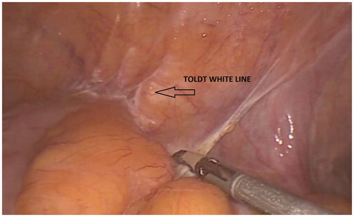 Figure 11. Toldt white line is intended as either the whitish line of lateral peritoneal reflection along the outer edge of the ascending and descending colon (see picture) or the junction of parietal peritoneum with Denonvilliers fascia. This picture shows the whitish line of incision of the peritoneal reflection along the descending colon.