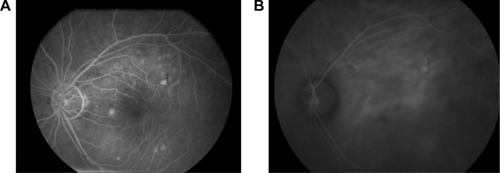 Figure 1 (A) FA and (B) ICGA studies of patient 1 prior to treatment with combination PDT and bevacizumab demonstrating (A) late focal leakage in the papillomacular bundle as well as focal staining and a PED and (B) ICGA showing increased choroidal perfusion and probable focal PED. No definitive CNV was identified.
