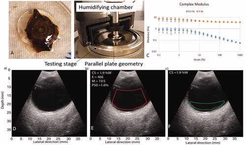 Figure 5. (A) Intact human vitreous humour attached to the lens and the iris. (B) Experimental setup used for performing the rheometry of vitreous humor. (C) Amplitude sweep result of solid phase of human vitreous humor sample. Reproduced 1. Tram NK, Swindle-Reilly KE. Rheological properties and age-related changes of the human vitreous humor. Front Bioeng Biotechnol (2018) 6:199. Licensed under CC BY 4.0. (D) Ultrasonograph of healthy eye showing no visible echodensities. (E) Demarcation of whole-central vitreous ROI outlined in red in posterior segment of eye from ultrasonography. (F) Demarcation of whole-posterior vitreous ROI outlined in green in posterior segment of eye from ultrasonography. Used with permission of Association for Research in Vision & Ophthalmology (ARVO), from Mamou J, Wa CA, Yee KMP, Silverman RH, Ketterling JA, Sadun AA, Sebag J. Ultrasound-Based Quantification of Vitreous Floaters Correlates with Contrast Sensitivity and Quality of Life. Invest Ophthalmol Vis Sci, 56, (2015); permission conveyed through Copyright Clearance Center, Inc.