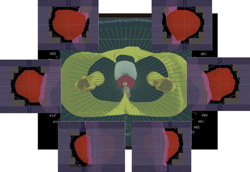 Figure 1.  A single-arc VMAT plan with 73 CPs and 5-degree gantry angle spacing for a prostate cancer patient has been created by ERGO + + treatment planning system, where MLC shapes are given by anatomies of target and organs at risk and monitor units for each CP is optimized by simulated annealing algorithm based on given dose prescriptions. The red and pink regions are PTV and rectum, respectively.