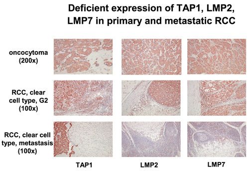 Figure 5.  Immunohistochemical analysis of primary and metastatic RCC lesions. Immuno-histochemistry of a benign oncocytoma and of RCC lesions was performed using anti-APM-specific antibodies.