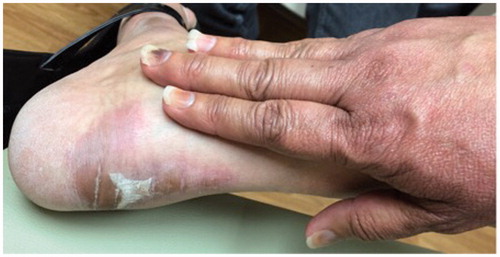 Figure 2. Presence of erythematous-violaceous scaly plaques over the right Achilles tendon and onycholysis and subungual hemorrhages on the nails.
