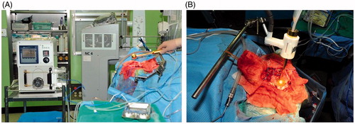 Figure 6. Photographs of the hyperthermia device being applied to a patient during the clinical trial. (A) Photograph illustrating how the modified hyperthermia device was applied to a patient in an operating room setting. (B) The hyperthermia device was applied intra-operatively after total resection of the metastatic brain tumor was performed.