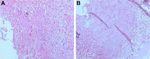 Figure 6 Microscopic examination of the specimen showed granulomatous tissue with structureless coagulative necrosis and fibrinoid necrosis (A and B).