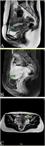 Figure 7. MRI for patient in 1st year after HIFU (Dec. 17th, 2021). (A) Sagittal T1-weighted image showed the mass’s size is 4.1 mm; (B) Post-contrast sagittal T1-weighted image showed the mass’s size is 3.9 mm; (C) Axial T2-weighted image showed the mass’s size is 4.8 mm.