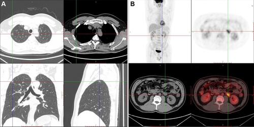 Figure 2 Positron emission tomography (PET)-CT whole body imaging. (A) A 15×10 mm shadow with ground glass density in the upper right lung was detected; (B) a neoplastic lesion with hypermetabolism close to the left renal hilum was shown.