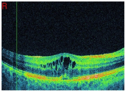 Figure 2 Optical coherence tomography showing cystoid macular edema.