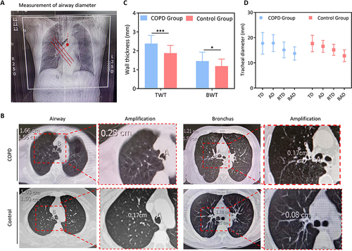 Figure 2 Clinical lung imaging changes in COPD. (A) Graphical representation of airway measurements in coronal chest CT. (B) Measurement of trachea and bronchus in horizontal chest CT. (C) Increased thickness of airway wall and bronchial wall on chest CT in COPD. (D) Diameter of trachea and right main bronchus between groups. *P < 0.05, ***P < 0.001.