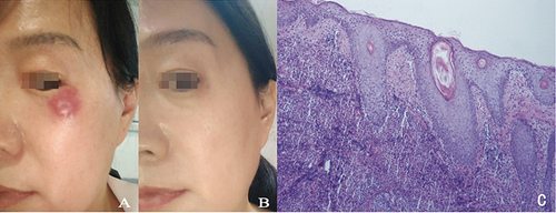 Figure 1 Sweet syndrome manifestation (A) edematous erythema on the left lower eyelid with a central blister; (B) Facial skin lesions subsided 1 month after treatment (C) Histopathological examination of the skin lesion (HE 40×) showed slightly increased epidermis thick, diffuse infiltration of lymphocytes and neutrophils in the superficial dermis, vasodilation and congestion.