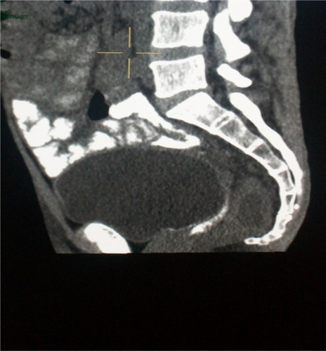 Figure 3 Computed tomography of pelvis.