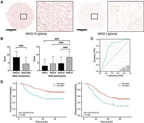 Figure 7 Immunohistochemical staining results of NOD1 in microarray cohort. (A) The immunohistochemical staining showing NOD1 expression were higher in WHO IV glioma tissues, compared to WHO I glioma tissues, bar=600μm. (B) Bar chart showing NOD1 expression score were significantly higher in WHO IV glioma tissues, compared to WHO I–III glioma tissues. (C) The ROC curve of microarray cohort. (D) Survival curve showing the high NOD1expression significantly related to the poor prognosis of glioma patients. ***p<0.001.