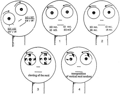 Figure 7. Right head tilt with left cycloversion. An opposing right cycloversion may be obtained by creating excyclotorsion of the right eye and incyclotorsion of the left eye. This may be obtained by (1) recess-resect of the oblique muscles [Citation103], (2) surgery on the four cyclovertical mucles: recession of the right SO and adjustable suture recession of the right SR (both incyclotortors), and recession of the left iO and adjustable suture recession of the left iR (both excyclotortors) [Citation107], (3) slanting of the four rectus muscles: an oblique recession of 7 mm of the superior fibers of the MR, the nasal fibers of the iR, the inferior fibers of the LR, and the temporal fibers of the SR creates incyclotorsion. Conjugate slanting of the rectus muscles in the other eye creates excyclotorsion [Citation93], (4) horizontal transposition of the vertical rectus muscle tendon. This transposition may be extended to any rectus muscle, depicted here as also involving horizontal rectus muscles [Citation105]. SO, superior oblique muscle; SR, superior rectus muscle; iO, inferior oblique muscle; iR, inferior rectus muscle; MR, medial rectus muscle; LR, lateral rectus muscle. Reproduced with permission from Spielmann [Citation93]