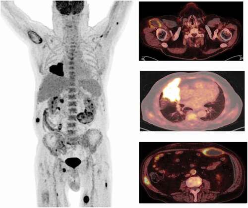 Figure 1. First PET-CT scan, November 2018