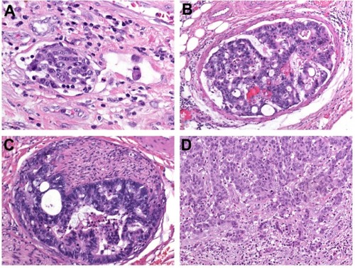 Figure 2 (A–D) Major prognostic variables in colorectal cancer. (A) Lymphatic invasion is diagnosed when tumor cells are present in vessels with an unequivocal endothelial lining, yet lacking a thick (muscular) wall; (B) blood vessel invasion refers to the involvement of veins, and is characterized histologically by the presence of tumor cells in vessels with a thick (muscular) wall or in vessels containing red blood cells; (C) perineural invasion is defined by tumor-cell invasion of nerves and/or spread along nerve sheaths; (D) tumor budding is characterized by the presence of isolated single cells or small clusters of cells composed of less than five cells scattered in the stroma at the invasive tumor margin.