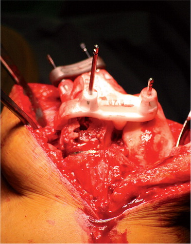 Figure 4. Repositioning of the guide after removal of the prosthesis using the three predrilled holes and insertion of the fourth pin.