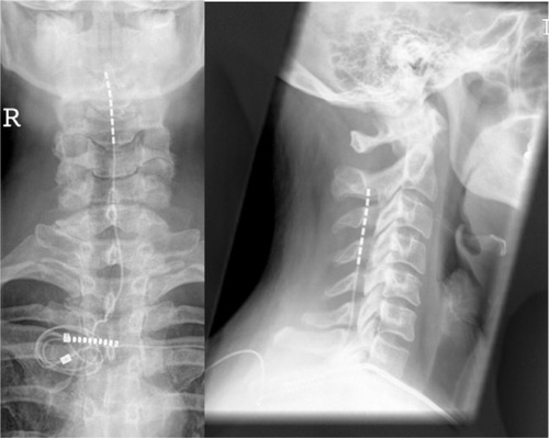 Figure 3 Anteroposterior and lateral view of a cervical spinal cord stimulation placement; the 8-pole lead (octrode) is positioned at level C3-5, and the spinal canal is entered at level TH2/3.