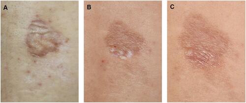 Figure 1 The lesion at time of presentation (A), after topical treatment (B), after FxCO2 in combination with subsequent cold and wet application (C), respectively.