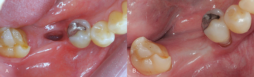 Figure 5 Clinical appearance after 15 days of treatment (A) and 2-year follow-up (B).
