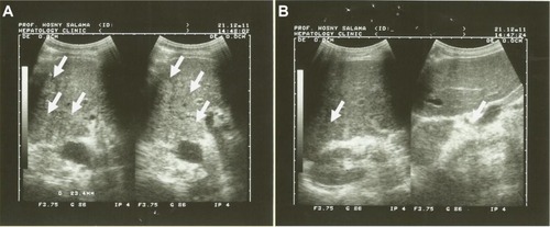 Figure 4 Pre- and postultrasound examination, time zero and after 3 months of the patient on Ambovex® treatment therapy.