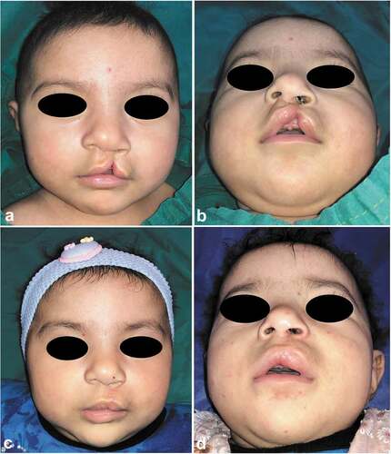 Figure 9. A case of Fisher’s group; 3-month-old female, with left-sided unilateral incomplete cleft lip. (a and b) Preoperative frontal and submental views and (c and d) 6 months’ postoperative frontal and submental views
