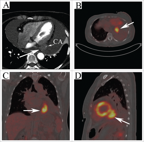 Figure 1. (A) Four chamber view of CT showing a hypo-intense tumorous mass extending from the left ventricle with the coronary artery infiltrating (arrow). FDG PET-CT shows a high uptake lesion (40 mm × 30 mm) located in the posterior-inferior of the left ventricle (arrows in B, (C) and D) with severe focal FDG activity (SUV max 9.0).
